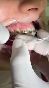 DENTAL KARET BEHEL GIGI ELASTIS / Rubber Band Elastic Untuk Perbaikan Gigi / Karet Ortho / Orthodontic Orthodontics Behelldental Ukuran 1/4 1/8 3/8 3/16 5/16 ketebalan 3.5 5 6.5 oz