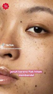 Viva Whitening Cream: Solusi Penghilang Flek Hitam & Bekas Jerawat