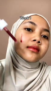 Solusi Peeling Intensif Scarlett: Mencerahkan & Memperbaiki Kulit Wajah