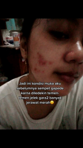 Paket Skincare Acne Glowing Orlin Beauty: Menyembuhkan Jerawat & Mencerahkan Kulit Wajah