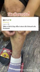 โปรพิเศษ 1แถม1 เพียง 290.- ครีมพญายอพลูคาว สมุนไพรแท้100% ส่งจากบริษัทโดยตรง