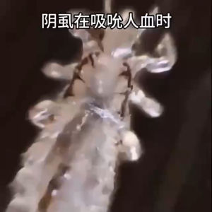 ANTI-BACTERIAL LICE EGG KILLER SPRAY anti bakteria pembunuh kutu Spray kutu kepala rambut ubat kutu kepala