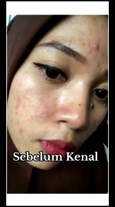 Serum Acne Orlin Beauty Mencerahkan Wajah Mengecilkan Pori Mengurangi Bekas Jerawat Bopeng Merawat Kulit Berjerawat 10 Ml BPOM