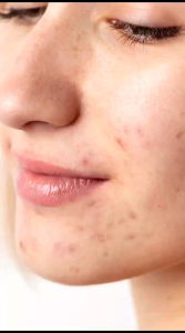 Face & Body Soap Bar 80gr - SKINSANE - Sabun Wajah & Tubuh - Membantu Mengatasi Kulit Kusam Berminyak & Berjerawat