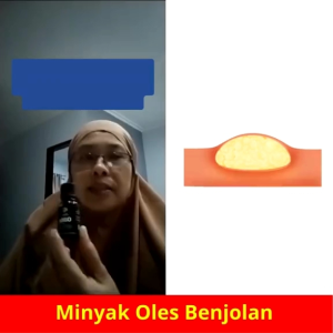 OILIFE ORIGINAL ASLI - MINYAK BENJOLAN OILIFE ASLI | OILIFE OBAT BENJOLAN ORIGINAL | OBAT LIPOMA | PENGHILANG BENJOLAN TANPA OPERASI
