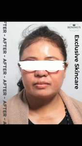 Day Cream Exclusive Silver utk Flek Hitam dan Melasma Benings Skincare by Dr Oky Benings Clinic