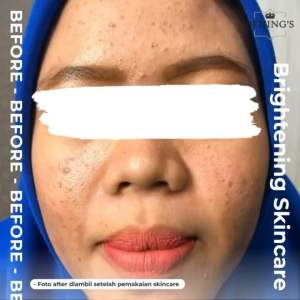 Brightening Day Cream Silver Benings Skincare by dr. Oky Pratama Benings Indonesia Krim Siang Pencerah Untuk Kulit Normal Perawatan Kulit Mineral Dari Benings - Lazada