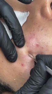 Tế bào gốc xử lý mụn medula (acne 8ml)