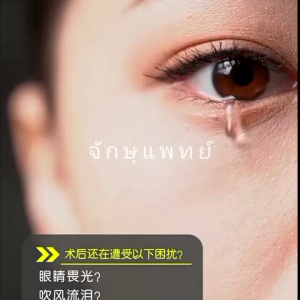 แว่นตา สำหรับคนผ่าตัดตา ชนิดโพลาไรซ์ มี moisture protection