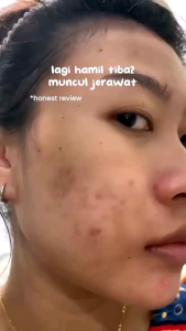 Paket Anti Acne Obat Jerawat Formula Cepat Kering I MELLYDIA Acne B 5pcs BPOM