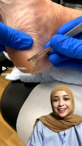 TUMITKU KAKI PECAH-PECAH DAN KAPALAN