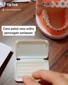 Wax Ortho Behel: Pencegah Sariawan Lilin Dental & Aksesoris Orthodontic