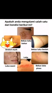 SALEP PENGHILANG BEKAS LUKA SCAR CACAR