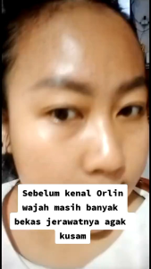PAKET FLEK/ULTIMATE PLATINUM ORLIN BEAUTY (TANPA TONER)