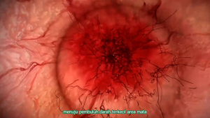 Obat Mata Katarak Rabun Redapro Bharata Original