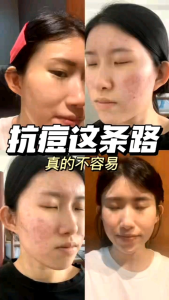 ✨小红书爆款 现货秒发1个疗程解决敏感肌肤✨[JSSUI Balancing Hydrating Ampoule ] 平衡保湿缩水精华液+神经酰胺保湿精华液＋✨[Facial Treatment Gel] 大黑瓶婴儿肌＋✨[ Perfect Shine ]防蓝光防紫外线顶级燕窝美白防嗮霜＋✨[Active Oxygen Camellia Cleanser ] 天然活氧自动发泡洗脸霜+✨[SOOTHING HYDRO VITAMIN - LUSTER CAVIAR PEARLY ] 保湿水光鱼子酱珍珠面膜