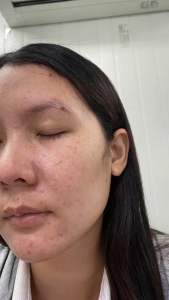 5 หลอด VIVONTE ครีม ดูแล ผิวหน้า รอย ดำ สิว กระฝ้า ฝังลึก หลัง เลเซอร์ WHITENING AND SPOT CORRECTOR 20 GM