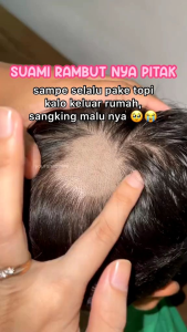 Youra Hair Tonic Growth serum | Penyubur rambut dan mengatasi rambut rontok 100ml