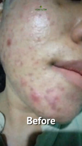 Varinutie All In One Acne Day Cream | Cream Siang Untuk Wakah Berjerawat Dan Bruntus