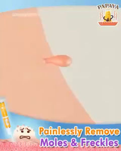 SKIN Tag remover Mole corn remover krim penaggal ketuat kutil tahi lalat jeragat freckle remover cream