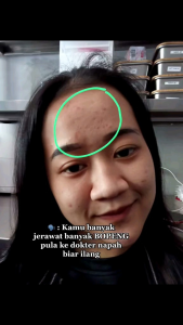 Facial Wash Anti Acne Orlin Beauty / Sabun Cuci Muka Khusus Wajah Berjerawat / Skincare BPOM