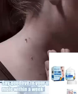 EELHOE WART REMOVAL Skin tag krim penanggal Ketuat Kutil Biji kolestrol Tattoo Bintik Hitam Jeragat tahi lalat
