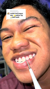 Sikat Gigi Elektrik 5Pcs/Set Smart Ultrasonic Scaling Alat Pembersih Karang Plak Sikat Gigi Elektrik