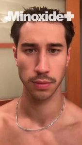 Serum Rambut MINOXIDIL Minoxide+ 5% – Mengurangi Kerontokan & Merangsang Pertumbuhan Rambut Baru (FREE DERMAROLLER*)