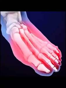 南京同仁堂 灰指甲 液指甲增厚黑变亮甲脱甲膏软甲液 30ml Nanjing Tong ren tang onychomycosis liquid nail thickening and blackening nail polish remover soft armor liquid.30ml