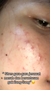 Paket Acne Glowing Orlin Beauty: Perawatan Kulit Wajah Terbaik