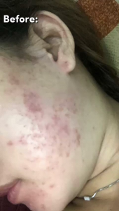 Krim Glow Acne: Perawatan Kulit Wajah yang Efektif