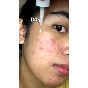 GLOW FX Acne Pure serum - serum untuk jerawat meradang terlaris