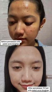 Paket Acne Glowing Platinum: Solusi Skincare untuk Kulit Sensitif & Bekas Berjerawat