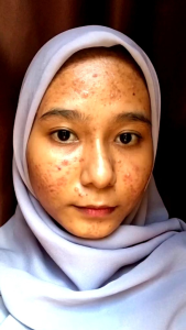 Paket Hemat ACNENO: Serum Jerawat & Serum Luminous Glow