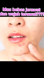 JGLOW SKINCARE PAKET EXTRA ACNE SOLUTION SULFUR - 5PCS