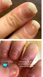 Obat Jamur Kuku Paling Ampuh – Aichun Beauty Nail Repair Cream | Pemutih & Perbaikan Kuku Rusak