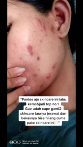Acne Day Orlin Beauty / Krim Siang Jerawat / Skincare bpom