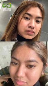 Kasoy Cream 5g WARTS REMOVER/MOLE REMOVER/SKINTAG REMOVER With Kasoy Oil for KALYO KULUGO BALAKUBAk