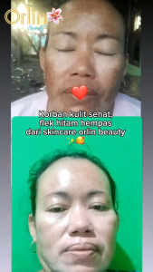ORLIN BEAUTY SKINCARE FLEK PLATINUM ORLIN AMPUH FLEK TEBAL MENAHUN GONTA GANTI SKINCARE ORIGINAL BPOM