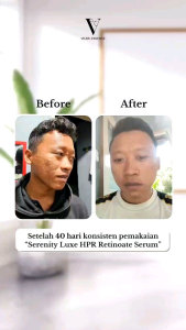 Serenity Luxe HPR Retinoate Peptide Serum ( Serum Malam )