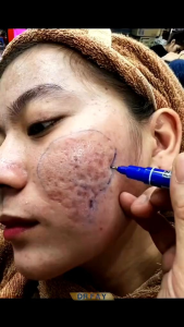 PROMO CRECM PENGHILANG Jerawat RESMI HILANG BPOM | ORIGINAL BEAUTYHACKS