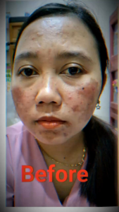 Paket Acne Hemat Orlin Beauty Membantu Meredakan Jerawat Beruntusan