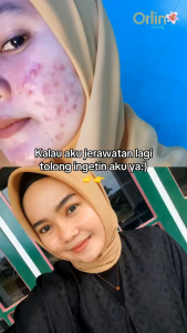 NIGHT CREAM ACNE ORLIN BEUTY MEMBATU MEREDAKAN JERAWAT MERDANG BERUNTUSAN