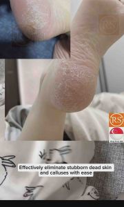 ❤Foot Dead Skin Removal❤Callus Remover Foot File Scraper Pedicure Tools Nail Cut Manicure❤️SG Seller❤️