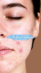 Ceramide Moisturizer SR12 Pelembab Wajah 18gr - Memperbaiki Skin Barrier - untuk Semua Jenis Kulit & Kulit Wajah Berjerawat