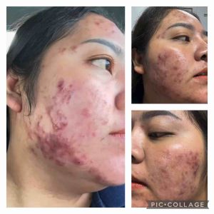 AMOUR ACNE XL SET (เซตใหญ่)