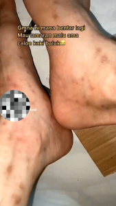 Sabun penghilang bekas luka hitam lama penghilang bekas koreng bekas cacar Sabun herbal original Bpom