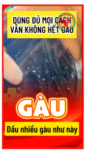 Dầu gội trị gàu Selenium Disulfide nhanh khô