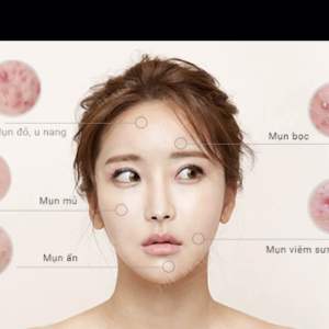 Serum Mụn Cao Hồng Sâm ELBON - Chiết Xuất Từ Hồng Sâm Trên 6 Năm Tuổi - Cân Bằng và Bổ Sung Dưỡng Chất Quý Giúp Da Sáng Khoẻ