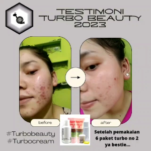 CREAM TURBO 2 Day and Night Cream For Oily and Acne Skin